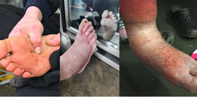 PIctures of scaly, puss encrusted and insect infected feet